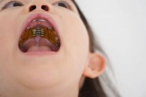 子供の歯列矯正